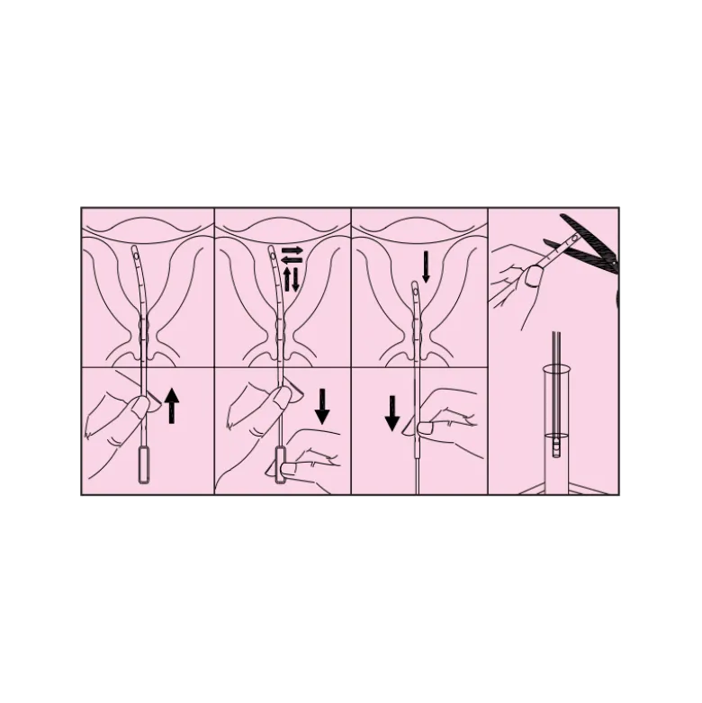 Curette d'aspiration endométriale stérile 1 trou pour prélèvement (boite de 100)