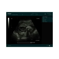 Echographe portable à ultrasons Edan DUS60 (niveaux de gris)