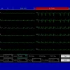 Electrocardiographe ECG Contec 1200G (12 pistes) avec interprétation