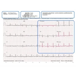 Electrocardiographe ECG de poche AliveCor Kardia 12L (12 pistes)