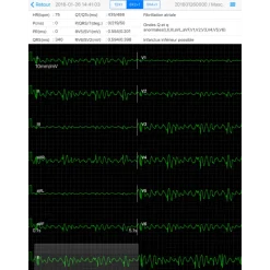 Electrocardiographe ECG Edan PADECG Numérique sans fil pour iPad avec interprétation