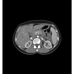 Fantôme abdomen pour tomodensitométrie radiographie et radiothérapie Erler Zimmer