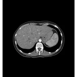 Fantôme abdomen pour tomodensitométrie radiographie et radiothérapie Erler Zimmer