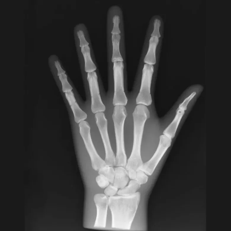 Fantôme radiographique de la main Erler Zimmer