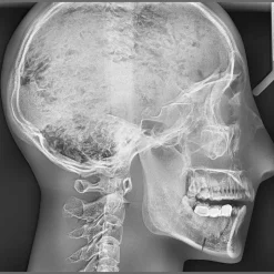 Fantôme radiographique de tête avec vertèbres cervicales Erler Zimmer