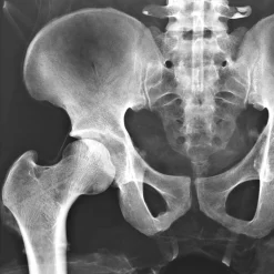 Fantôme radiographique du bassin Erler Zimmer flexible