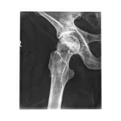 Fantôme radiographique du bassin Erler Zimmer flexible