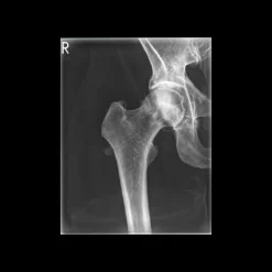 Fantôme radiographique du bassin Erler Zimmer flexible