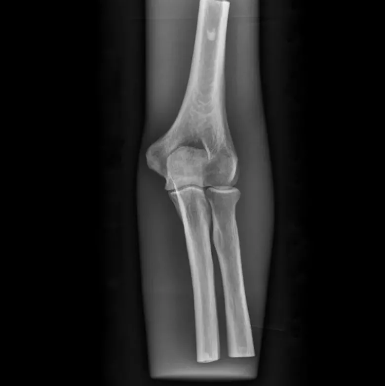 Fantôme radiographique du coude Erler Zimmer