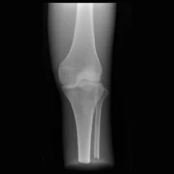 Fantôme radiographique du genou Erler Zimmer