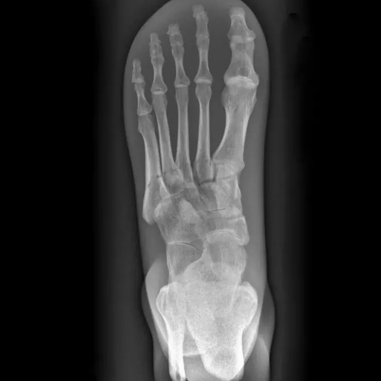Fantôme radiographique du pied Erler Zimmer