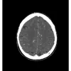 Fantôme tête et cou pour tomodensitométrie radiographie et radiothérapie Erler Zimmer