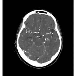 Fantôme tête et cou pour tomodensitométrie radiographie et radiothérapie Erler Zimmer