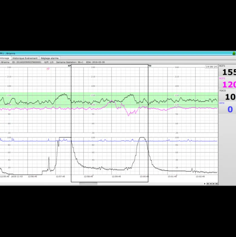 Logiciel PC MFM-CNS Lite pour cardiotocographe Edan F3