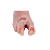Modèle anatomique de pied diabétique au stade sévère Erler Zimmer