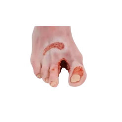 Modèle anatomique de pied diabétique au stade sévère Erler Zimmer