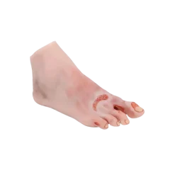 Modèle anatomique de pied diabétique au stade sévère Erler Zimmer