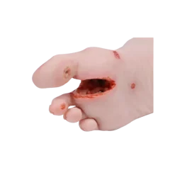 Modèle anatomique de pied diabétique au stade sévère Erler Zimmer