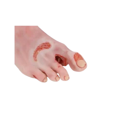 Modèle anatomique de pied diabétique au stade sévère Erler Zimmer