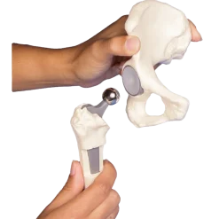 Modèle anatomique du joint de hanche (sain, malade, implant) Erler Zimmer