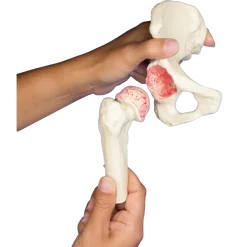 Modèle anatomique du joint de hanche (sain, malade, implant) Erler Zimmer