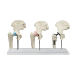 Modèle anatomique du joint de hanche (sain, malade, implant) Erler Zimmer