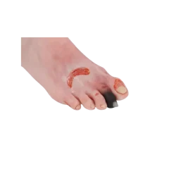 Modèle de pied blessé avec syndrome du pied diabétique Erler Zimmer