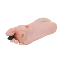 Modèle de pied blessé avec syndrome du pied diabétique Erler Zimmer