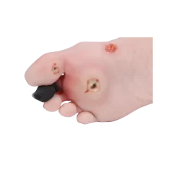 Modèle de pied blessé avec syndrome du pied diabétique Erler Zimmer