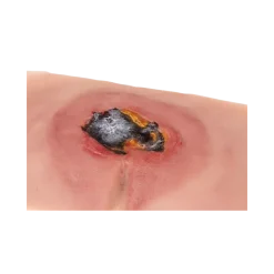 Modèle de plaie décubitus sacré non traité Erler Zimmer