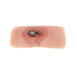 Modèle de plaie décubitus sacré non traité Erler Zimmer