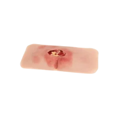 Modèle de plaie décubitus sacré nettoyé Erler Zimmer