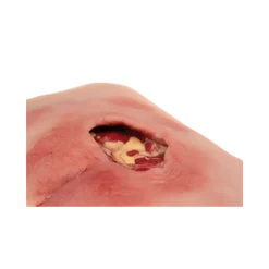 Modèle de plaie décubitus sacré nettoyé Erler Zimmer