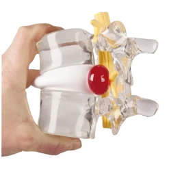 Modèle de simulation d'hernie discale Erler Zimmer