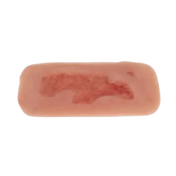 Modèle d'un ulcère artériel de la jambe en phase d'épithélialisation
