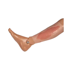 Modèle d'un ulcère artériel de la jambe en phase d'épithélialisation