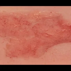 Modèle d'un ulcère artériel de la jambe en phase d'épithélialisation