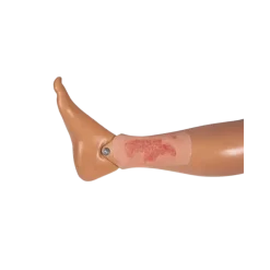 Modèle d'un ulcère artériel de la jambe en phase d'épithélialisation
