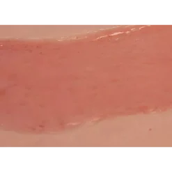 Modèle d'un ulcère artériel de la jambe en phase d'épithélialisation
