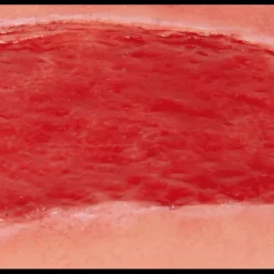 Modèle d'un ulcère artériel de la jambe en phase de granulation