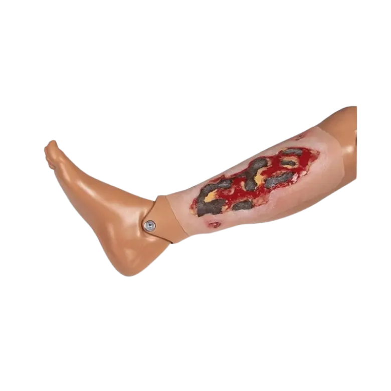 Modèle d'un ulcère artériel de la jambe en phase d'exsudation