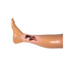 Modèle d'un ulcère artériel de la jambe en phase d'exsudation