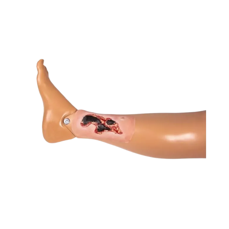 Modèle d'un ulcère artériel de la jambe en phase d'exsudation
