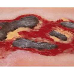 Modèle d'un ulcère artériel de la jambe en phase d'exsudation