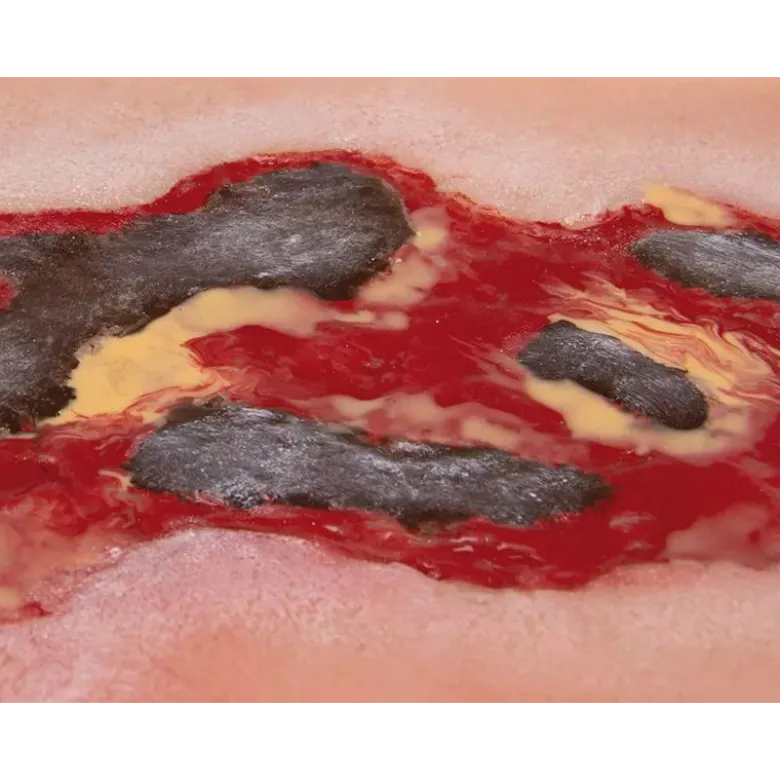Modèle d'un ulcère artériel de la jambe en phase d'exsudation