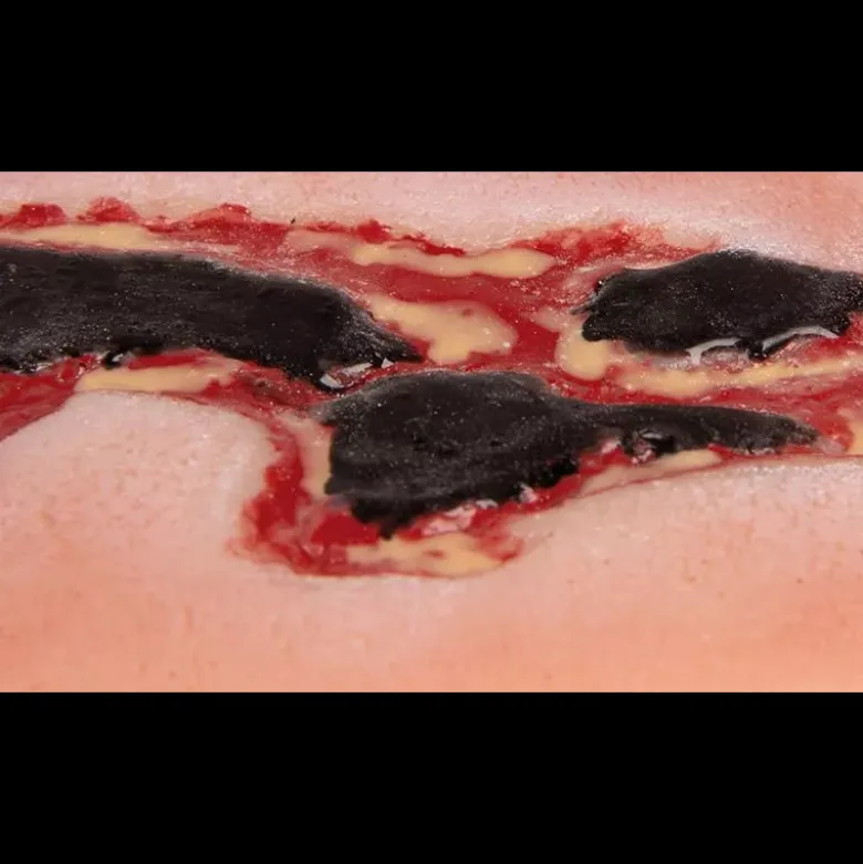 Modèle d'un ulcère artériel de la jambe en phase d'exsudation
