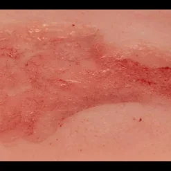 Modèle d'un ulcère veineux de la jambe en phase d'épithélisation