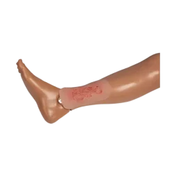 Modèle d'un ulcère veineux de la jambe en phase d'épithélisation