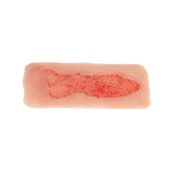 Modèle d'un ulcère veineux de la jambe en phase d'épithélisation