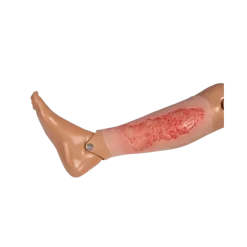 Modèle d'un ulcère veineux de la jambe en phase d'épithélisation